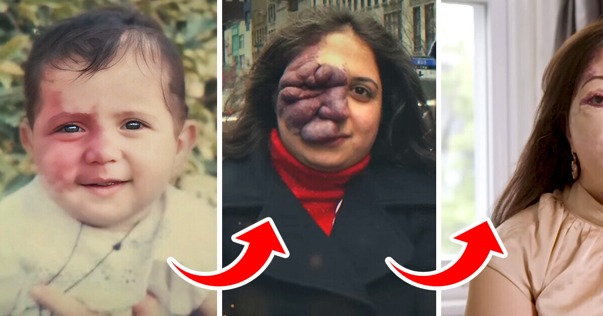 “People Said I Shouldn’t Leave The House,” Woman Who Was Born with Rare Birthmark Finally Get Her Confidence Back “People Said I Shouldn’t Leave The House,” Woman Who Was Born with Rare Birthmark Finally Get Her Confidence Back