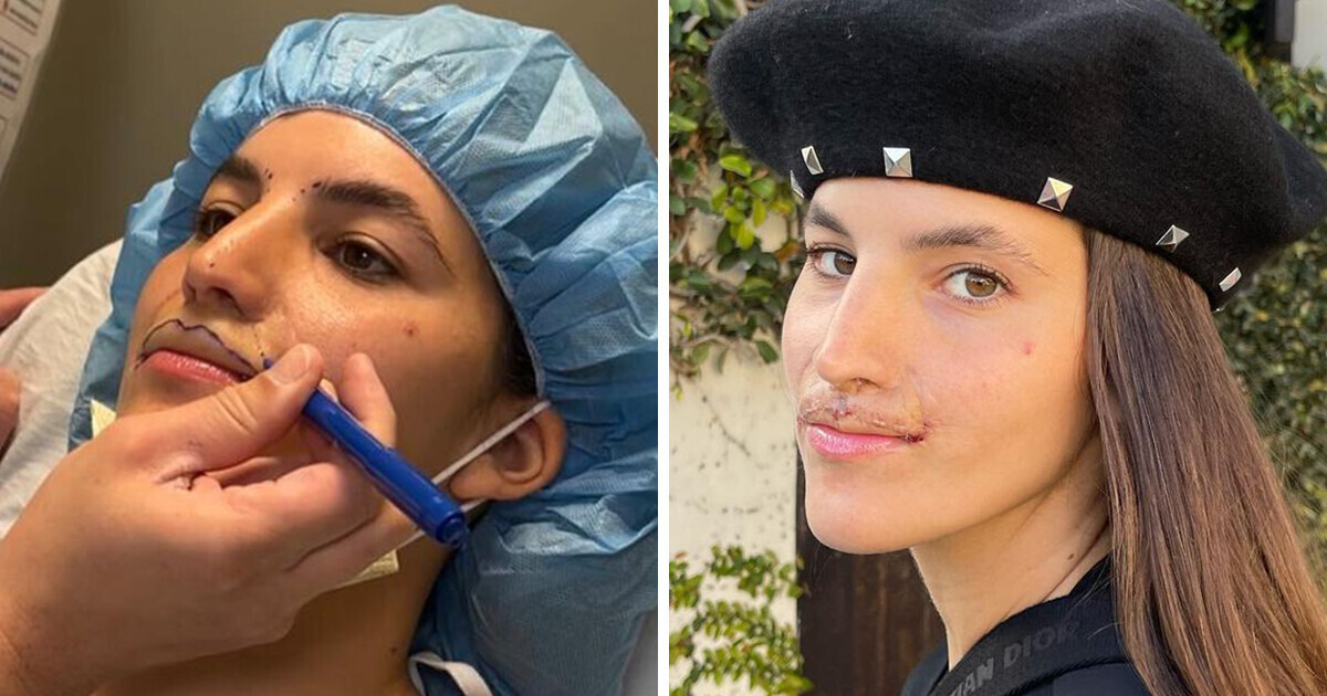 “so Blessed With The Results!” Model, Whose Lip Was Torn Off By A Pit 