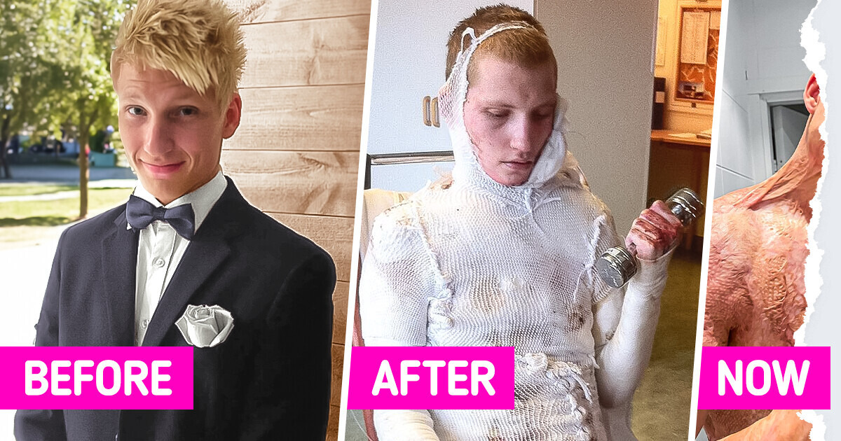 “I Blame Myself”: A Singer Embraces His New Look After Most of His Body Was Electrocuted “I Blame Myself”: A Singer Embraces His New Look After Most of His Body Was Electrocuted