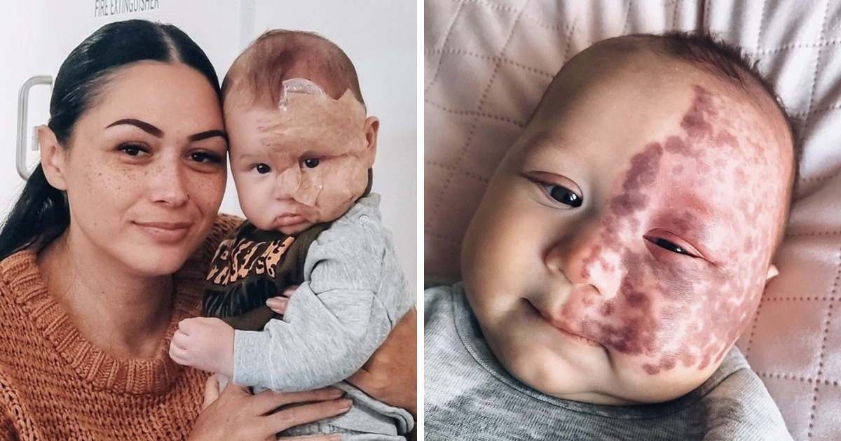 Mother, Who Used to be Trolled for Lasering Huge Birthmark on Her Tiny one’s Face, Unravels Her Reasons thumbnail