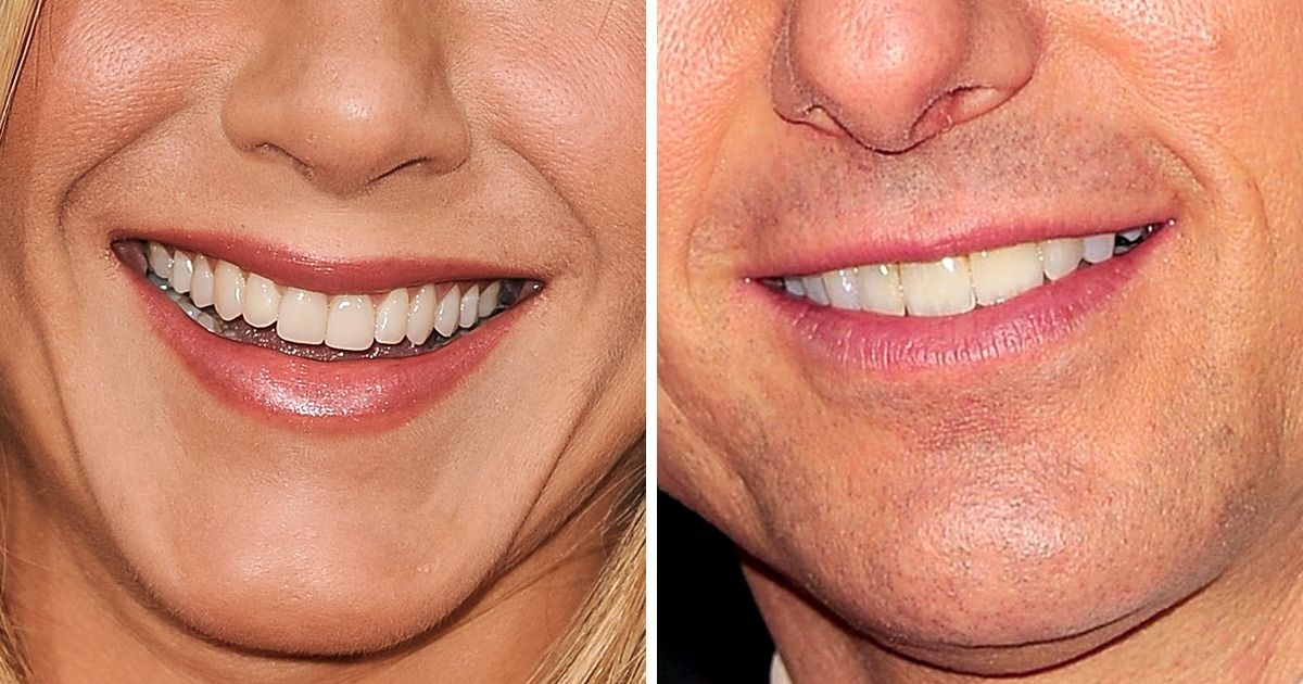 Nicki Minaj Teeth Veneers