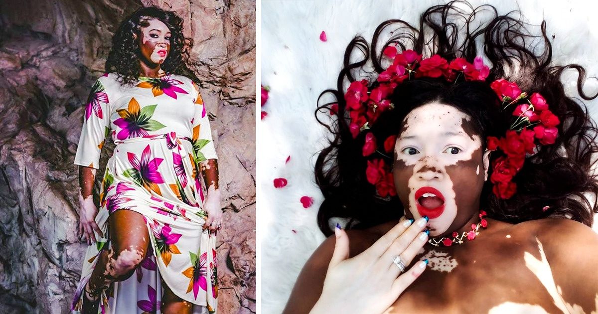 A Mother With a Rare Skin Condition Learns to Embrace Herself and Becomes a Model A Mother With a Rare Skin Condition Learns to Embrace Herself and Becomes a Model