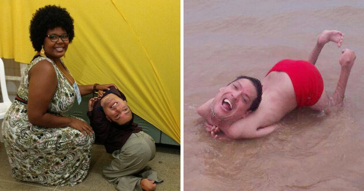 “I Want to Stay Like This,” A Man With an Upside-Down Head Refuses to Have Surgery and Succeeded in Inspiring People “I Want to Stay Like This,” A Man With an Upside-Down Head Refuses to Have Surgery and Succeeded in Inspiring People