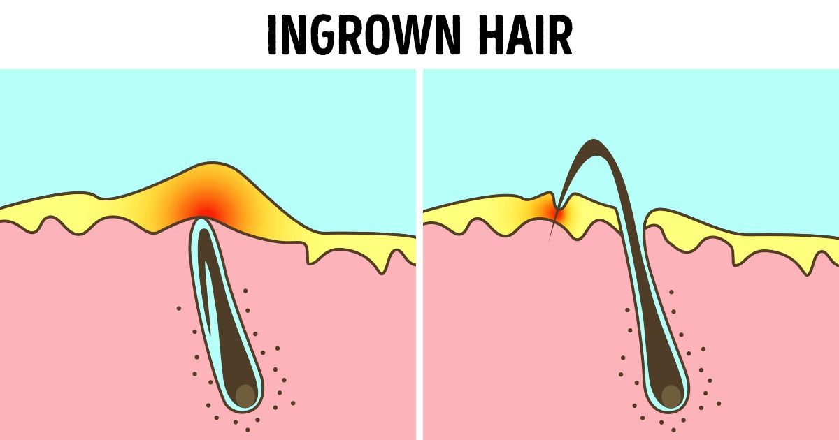 8 Signs You’re Removing Hair Incorrectly 8 Signs You’re Removing Hair Incorrectly