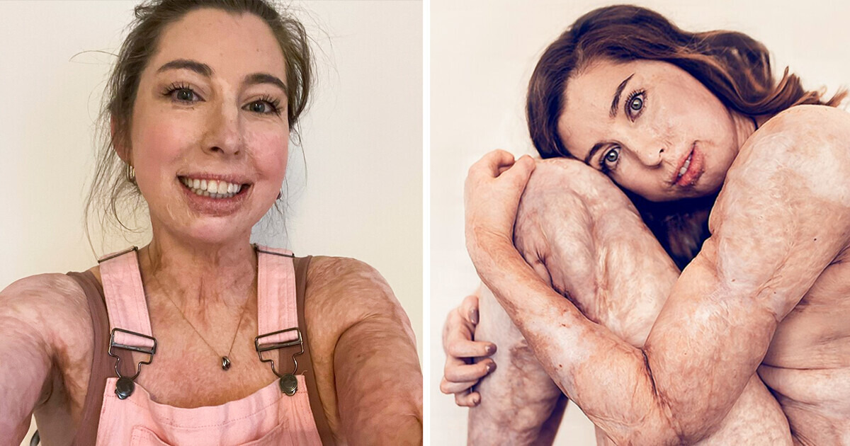 The Story of a Woman Who Survived Burns on 96% of Her Body and Shook Up the Beauty Industry The Story of a Woman Who Survived Burns on 96% of Her Body and Shook Up the Beauty Industry