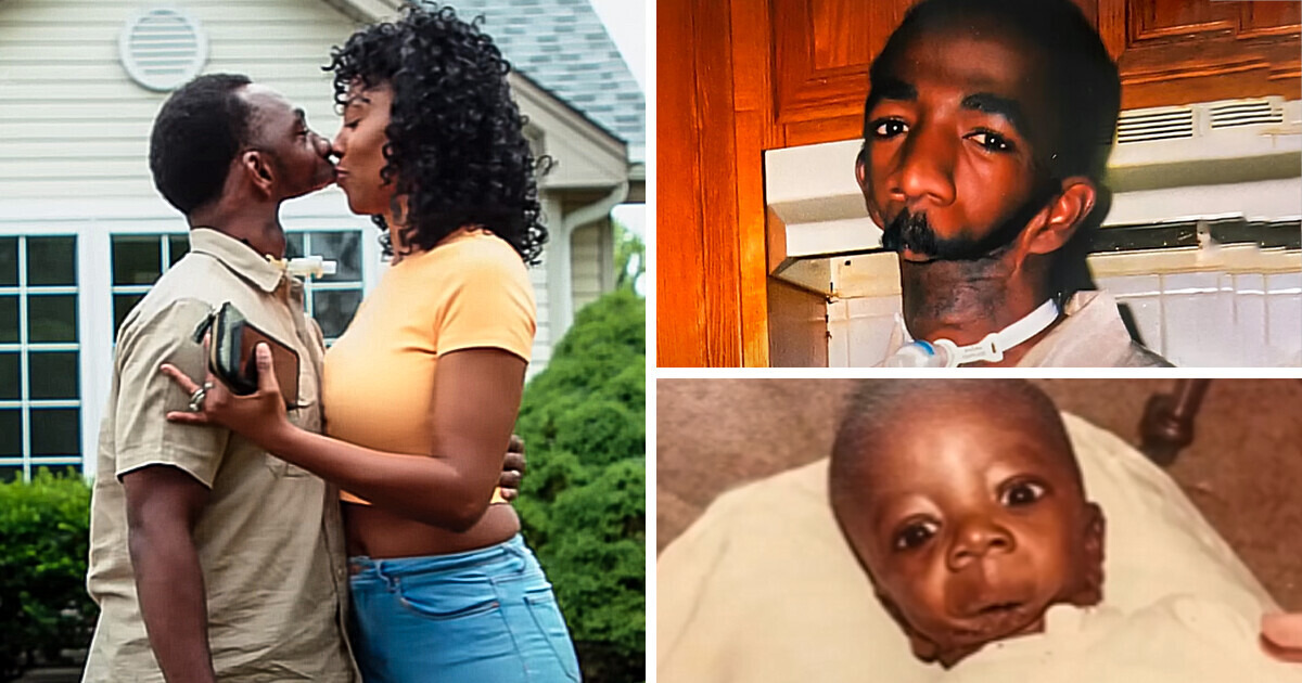 “She Can’t Kiss Him!” Man Without a Jaw Found True Love, Their Unique Relationship Sparks Controversies