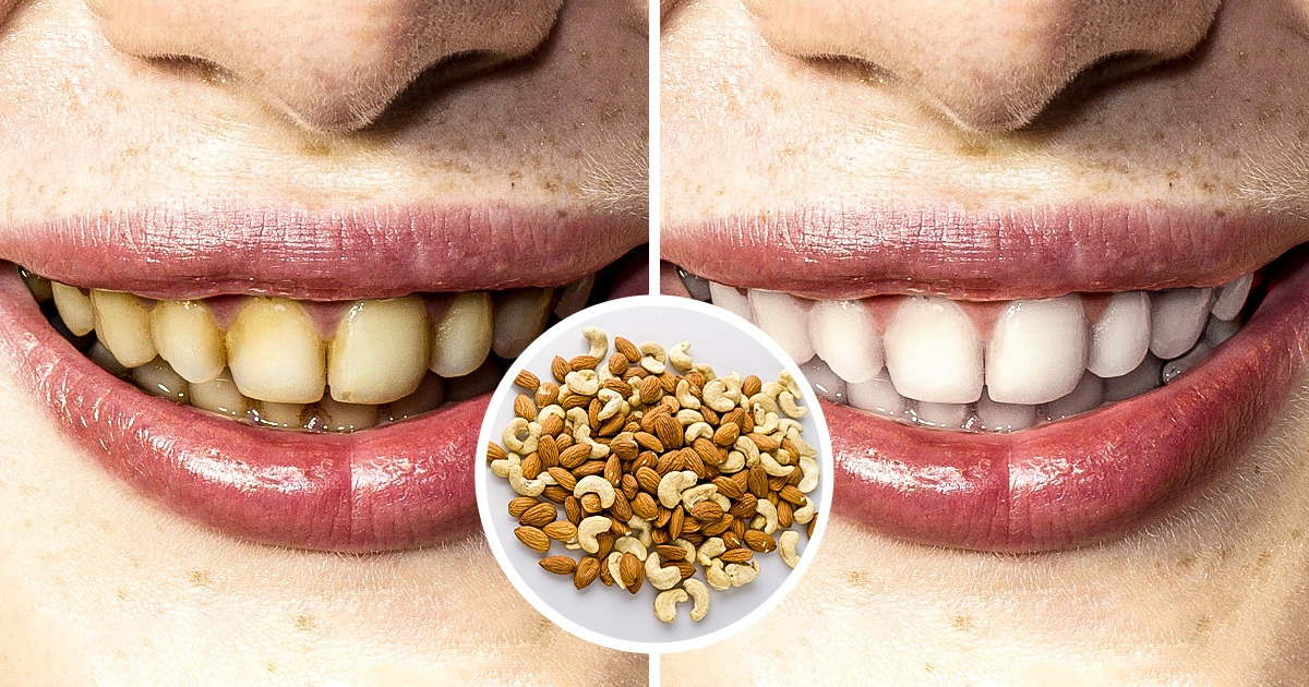 6 Ways to Safely Whiten Your Teeth