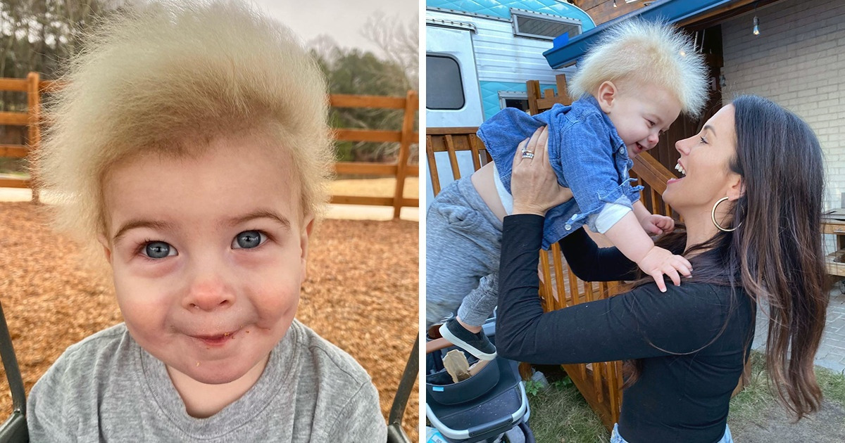 A Toddler Who Was Diagnosed With Rare “Uncombable Hair Syndrome” Instantly Won Our Hearts A Toddler Who Was Diagnosed With Rare “Uncombable Hair Syndrome” Instantly Won Our Hearts