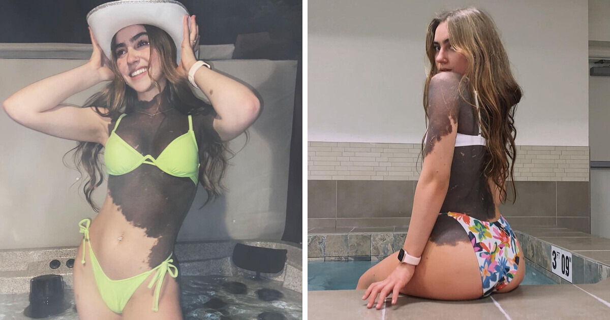 A Woman With a Rare Birthmark Wants All People to Normalize Being Different, “I Grew Up Without Seeing Anyone Like Me” A Woman With a Rare Birthmark Wants All People to Normalize Being Different, “I Grew Up Without Seeing Anyone Like Me”