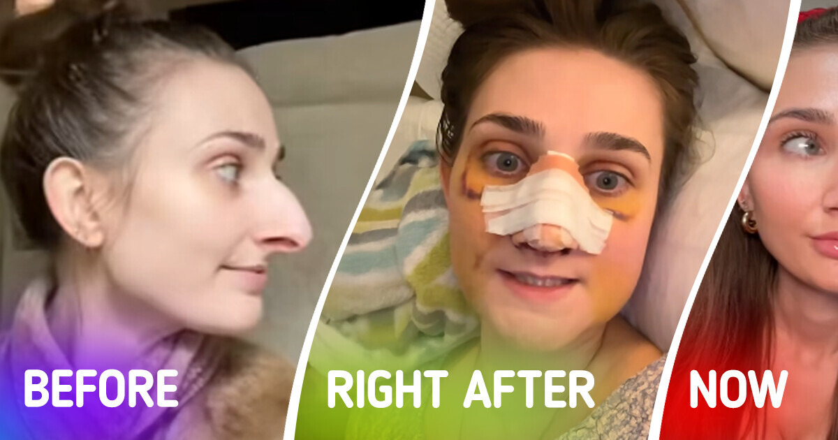 A Woman Shares the Results of Her Plastic Surgery, and the Transformation Has Everyone in Awe A Woman Shares the Results of Her Plastic Surgery, and the Transformation Has Everyone in Awe