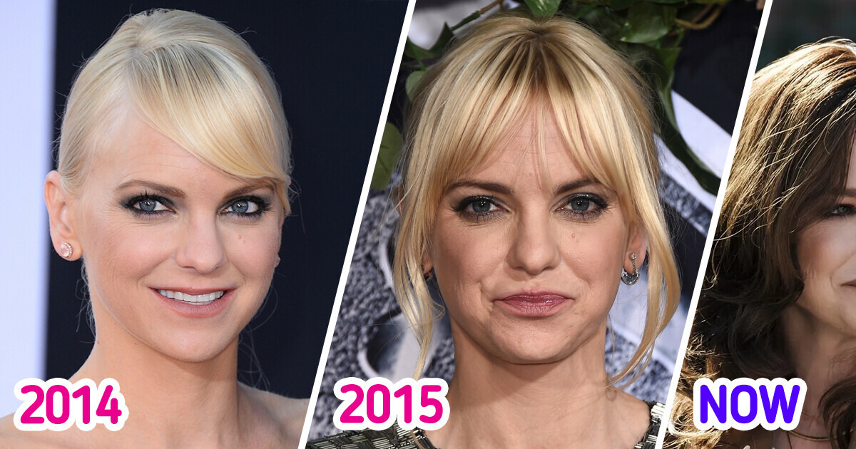 Anna Faris' Stunning Transformation: What She Looks Like Nowadays After Dissolving Her Fillers Anna Faris' Stunning Transformation: What She Looks Like Nowadays After Dissolving Her Fillers