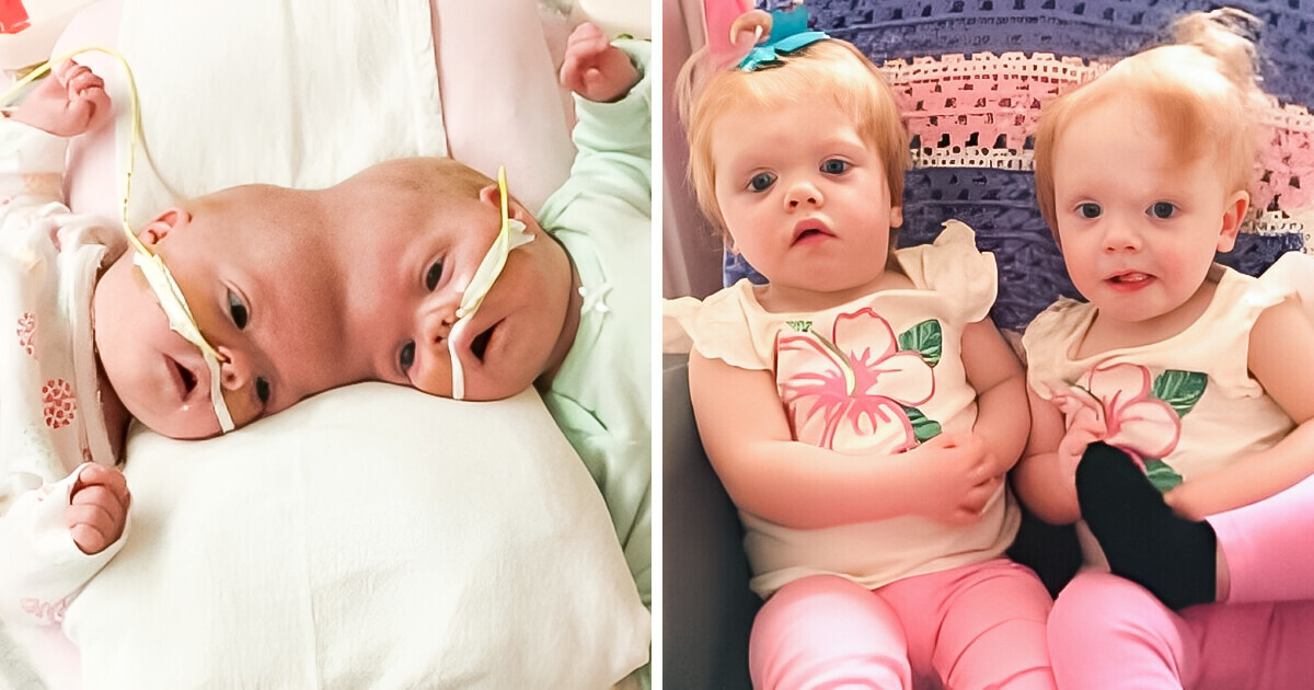 Formerly Conjoined Twins Beat 2% Survival Odds, and Reach Their First Life Goal