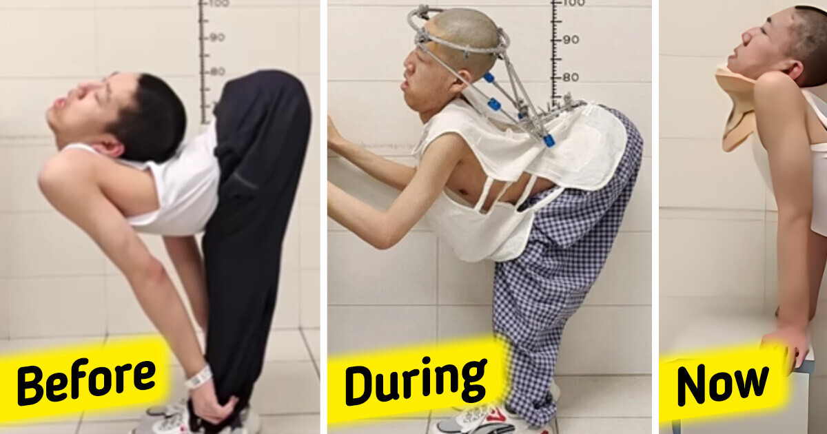 A Teen Who’s Called “Folded Boy” Took a Step Closer to Stand Up Straight Again After a High-Risk Surgery A Teen Who’s Called “Folded Boy” Took a Step Closer to Stand Up Straight Again After a High-Risk Surgery