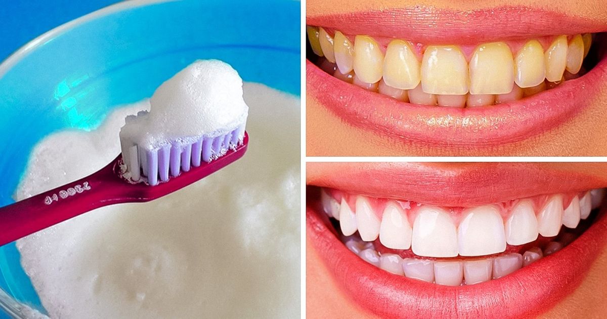10 Easy Ways to Naturally Whiten Yellow-Stained Teeth