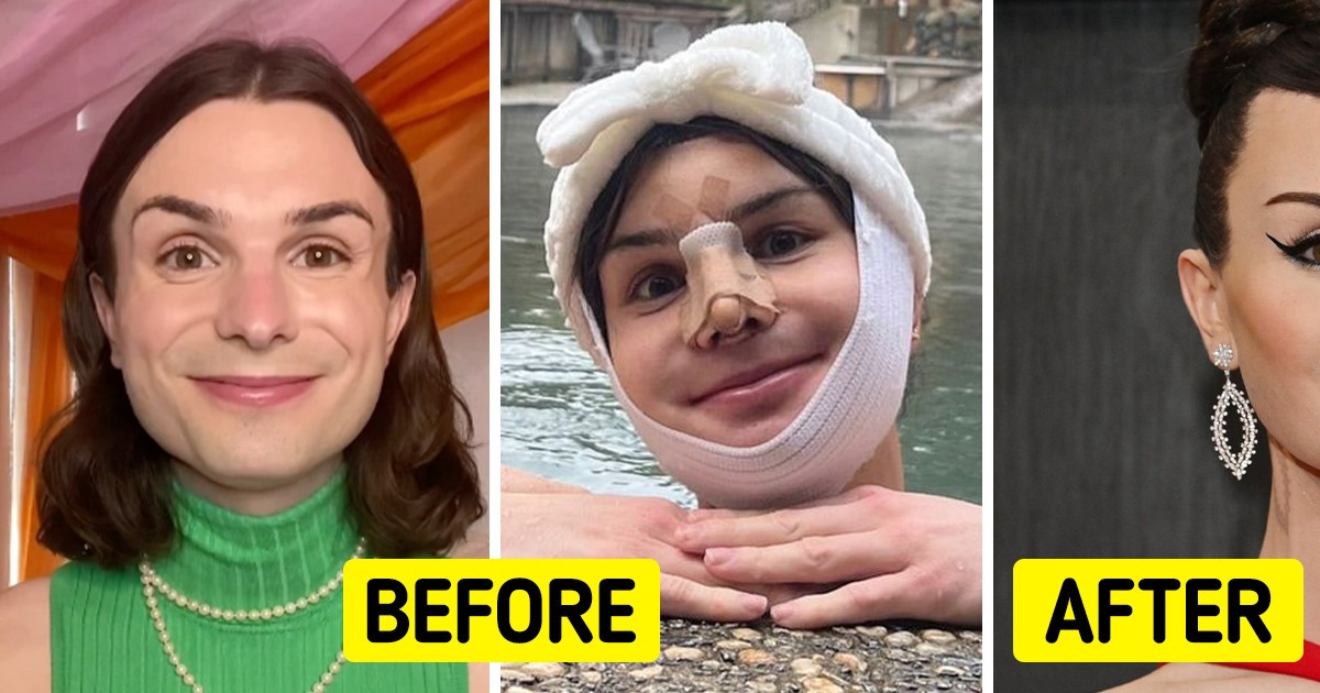 Trans Icon Dylan Mulvaney Reveals The Results Of Her Facial ...