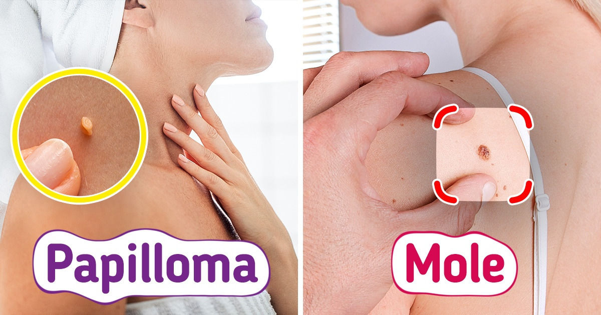 Why Moles Appear and Why It Is Important to Identify Them