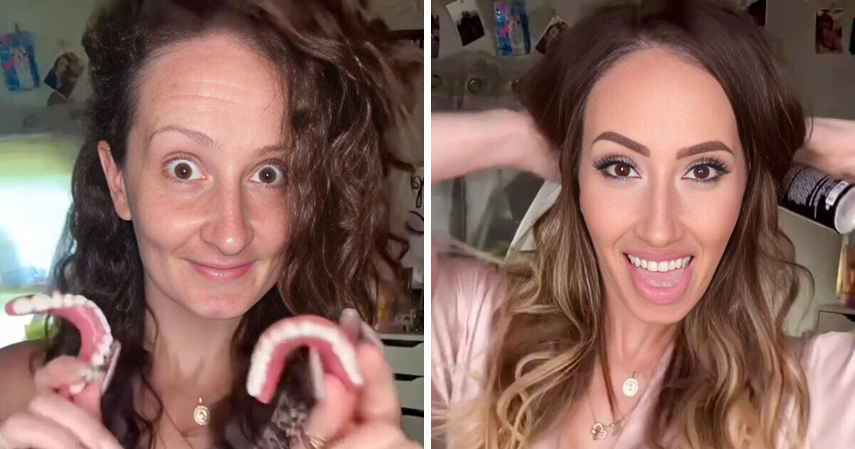 Mom Who Lost Teeth Due to Pregnancy Showes Her Transformations Mom Who Lost Teeth Due to Pregnancy Showes Her Transformations