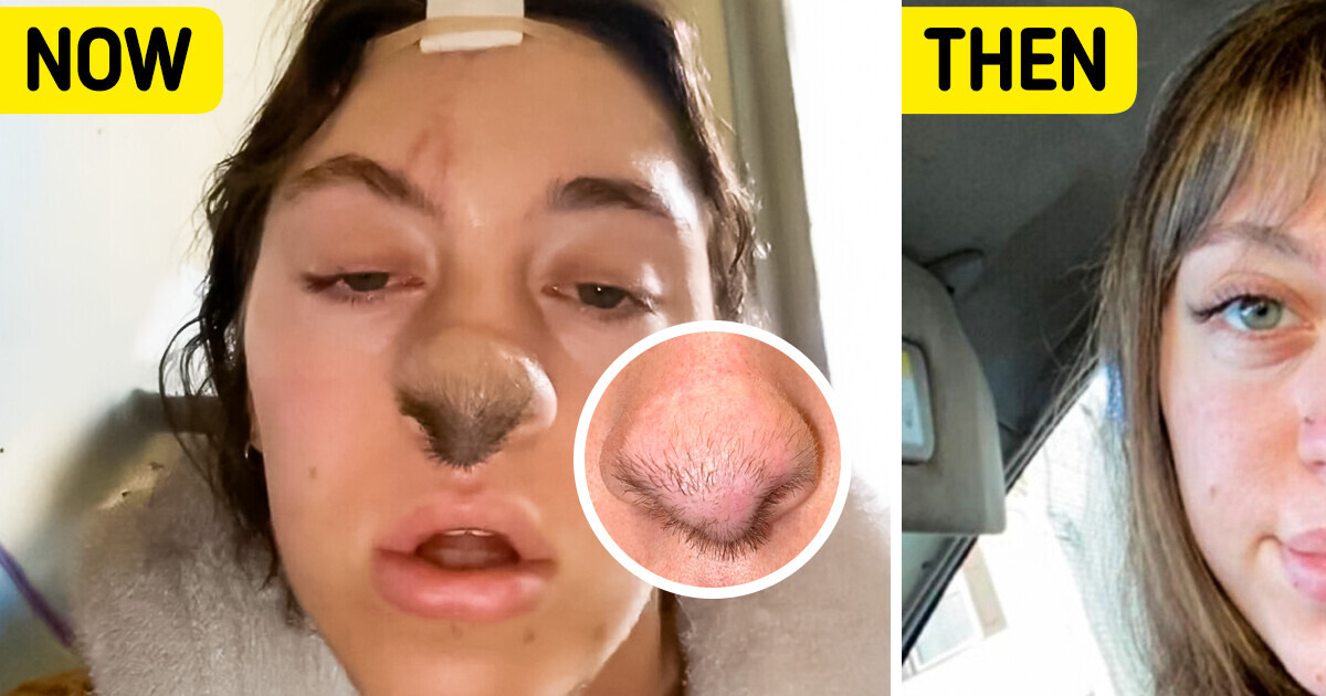 I Got Attacked by a Dog — Now I Have Hair Growing on My Nose I Got Attacked by a Dog — Now I Have Hair Growing on My Nose