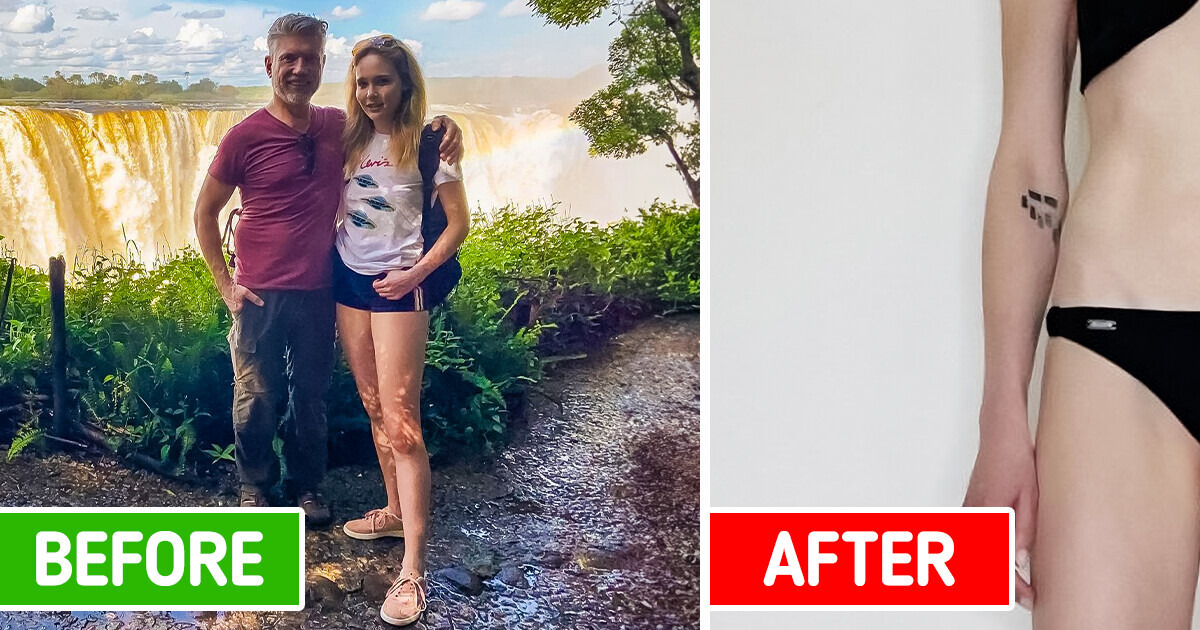 I Spent £130k Extending My Legs by 5.5 Inches Because My Husband Criticized My Appearance