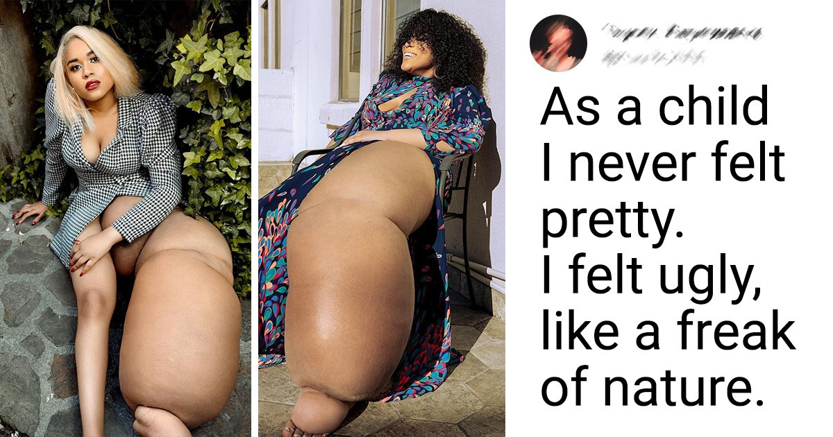 An Aspiring Model With a 100-lb Leg Embraces Her Uniqueness and Wants to Show the World That Being Different Is Beautiful An Aspiring Model With a 100-lb Leg Embraces Her Uniqueness and Wants to Show the World That Being Different Is Beautiful