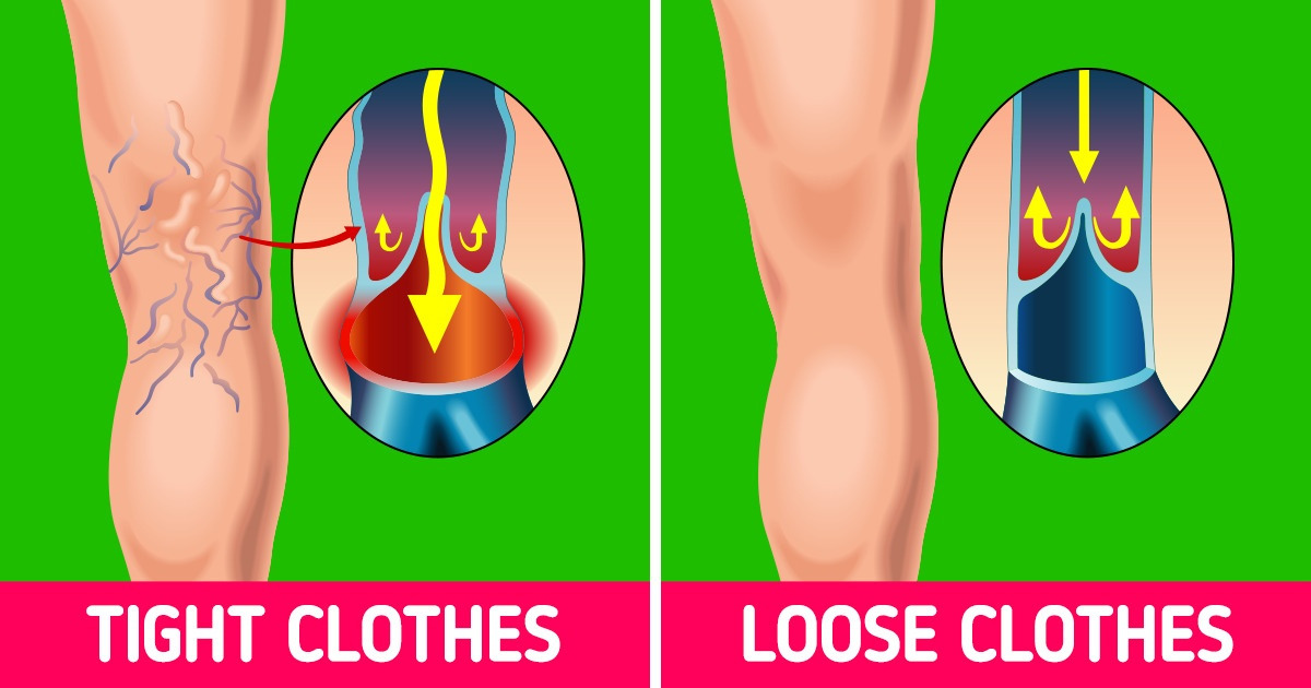 6 Ways to Make Varicose Veins Fade