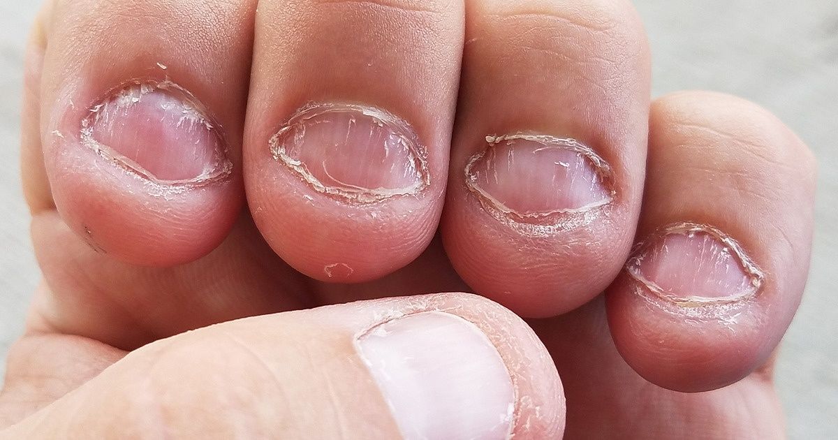 HOW TO STOP BITING YOUR NAILS, Gallery posted by Wurk
