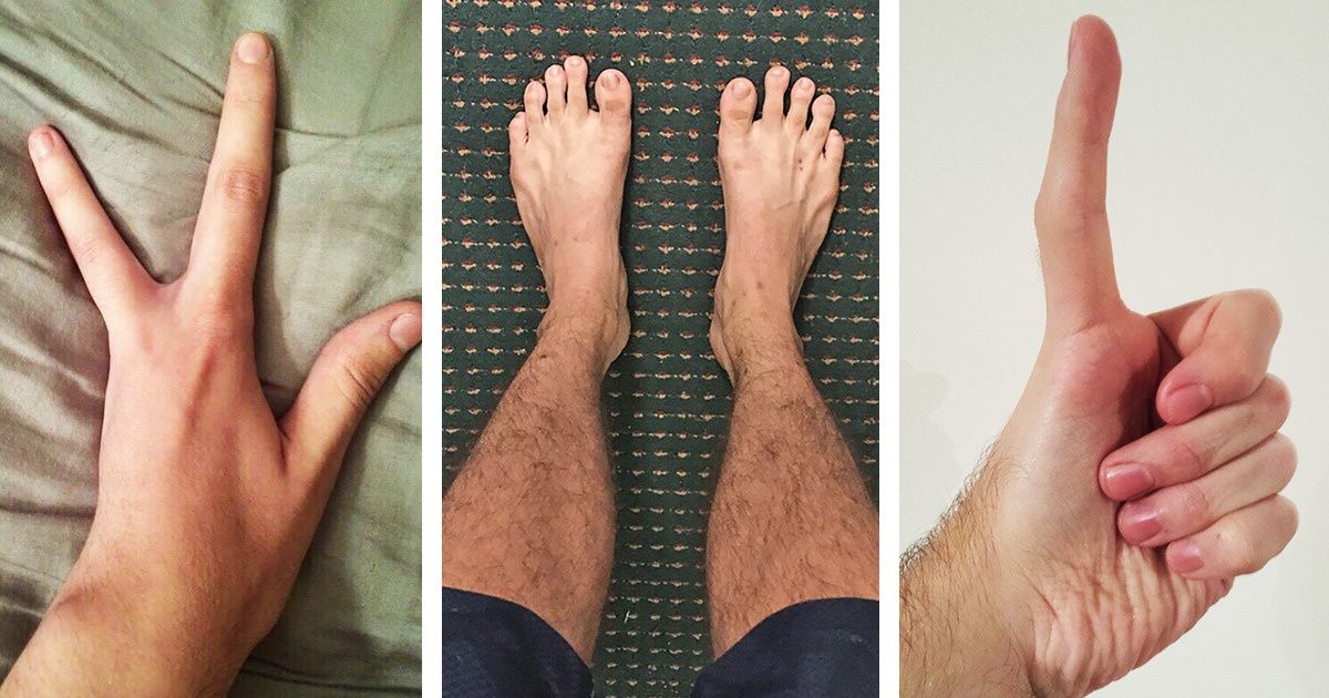 People Are Sharing Photos of Their Unusual Body Parts, and the Internet