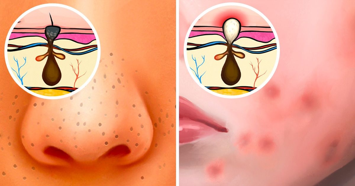 6 Types of Acne and What Might Cause Them 6 Types of Acne and What Might Cause Them