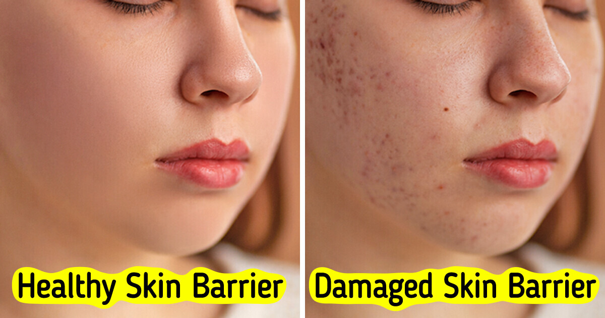 8 Warning Signs Your Skin Barrier Might Be Damaged 8 Warning Signs Your Skin Barrier Might Be Damaged