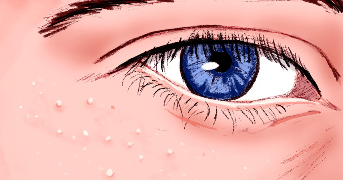 What Are Those White Pimples That Appear Around Your Eyes (Note: Don’t Squeeze Them!) What Are Those White Pimples That Appear Around Your Eyes (Note: Don’t Squeeze Them!)