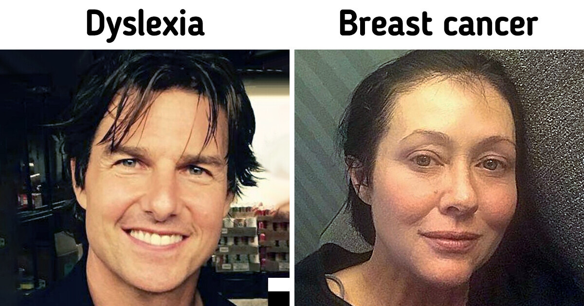 15 Celebrities Who Weren’t Broken by Serious Health Issues 15 Celebrities Who Weren’t Broken by Serious Health Issues