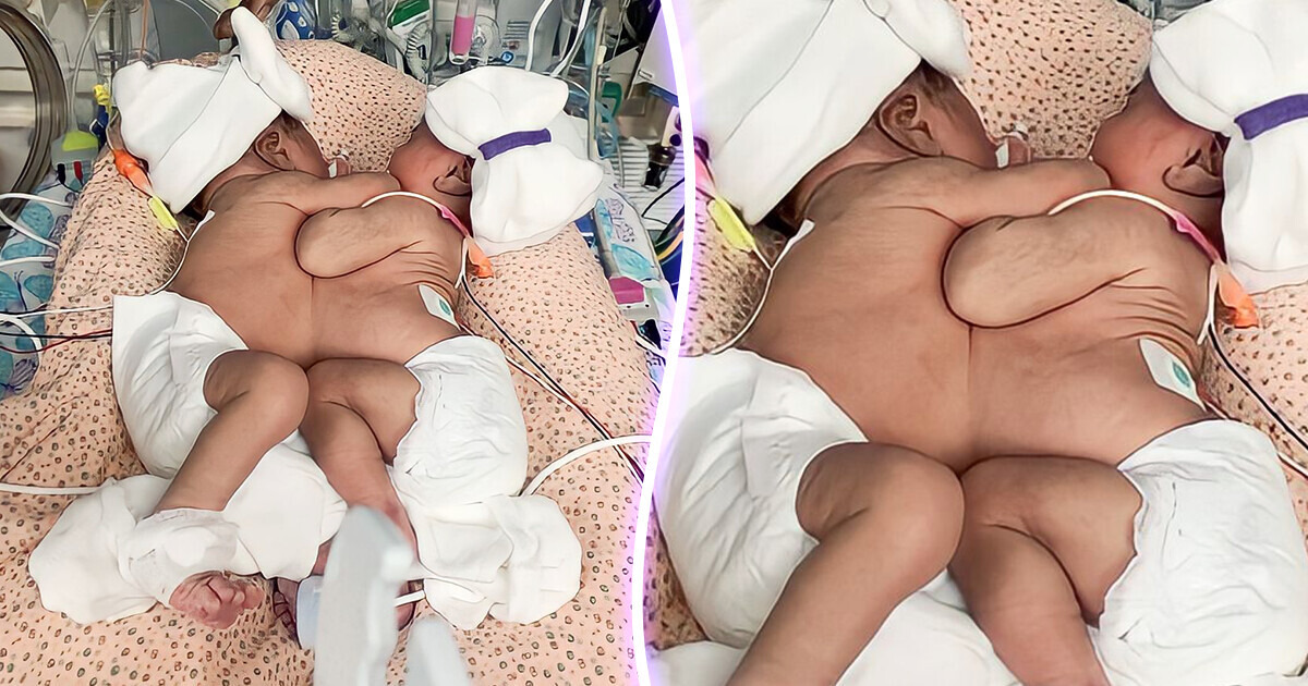 A Hospital Successfully Separated Conjoined Twins After an 11-Hour Surgery A Hospital Successfully Separated Conjoined Twins After an 11-Hour Surgery