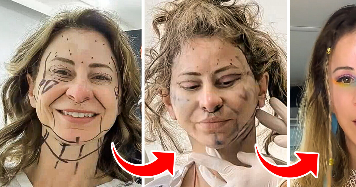 “My Face Is Dropping Fast,” A Woman Sold Her HOUSE for Beauty Procedure to Look Younger “My Face Is Dropping Fast,” A Woman Sold Her HOUSE for Beauty Procedure to Look Younger