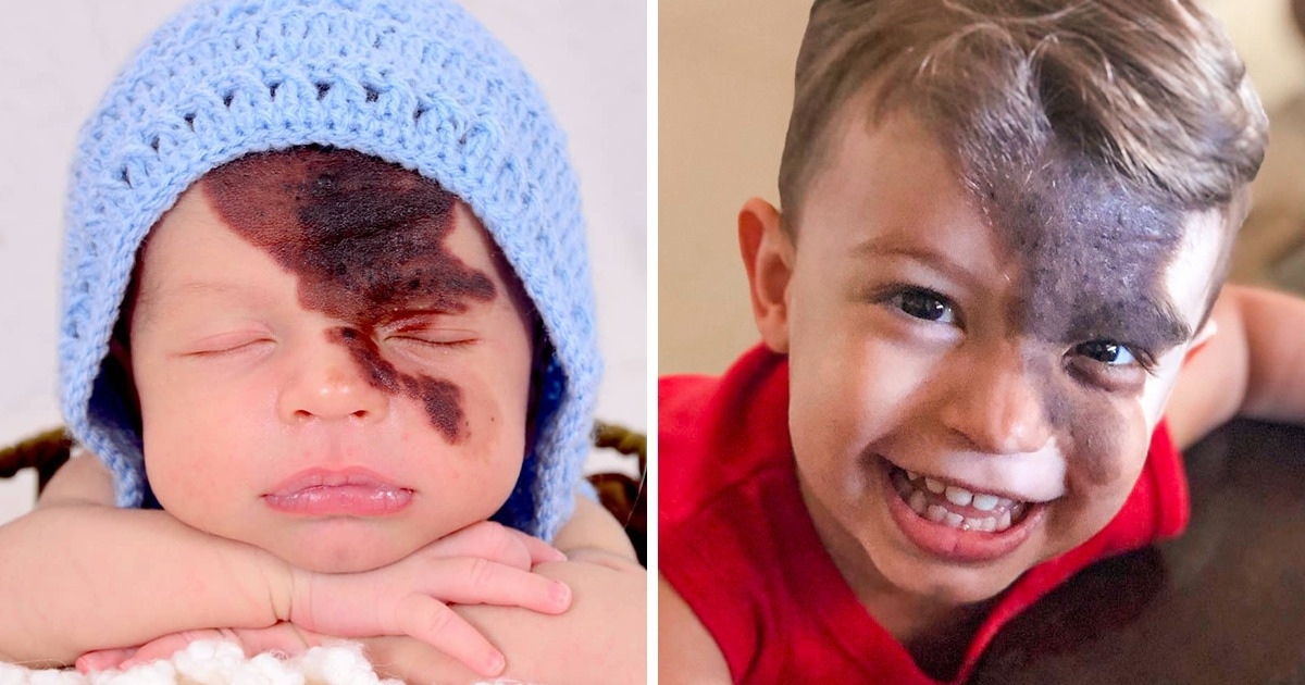 Meet Little Enzo, Whose Mom Found a Brilliant Way to Celebrate His Unique Birthmark