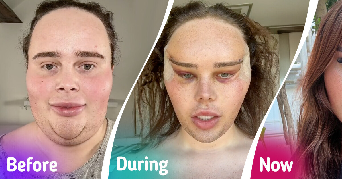 Influencer Reveals Dramatic Results of Her Fox Eye Plastic Surgery Influencer Reveals Dramatic Results of Her Fox Eye Plastic Surgery