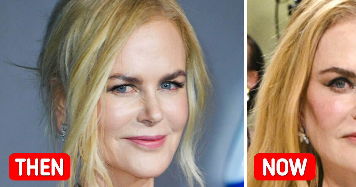 “Ruined Her Face”, Nicole Kidman’s Met Gala Look Sparks Concern “Ruined Her Face”, Nicole Kidman’s Met Gala Look Sparks Concern