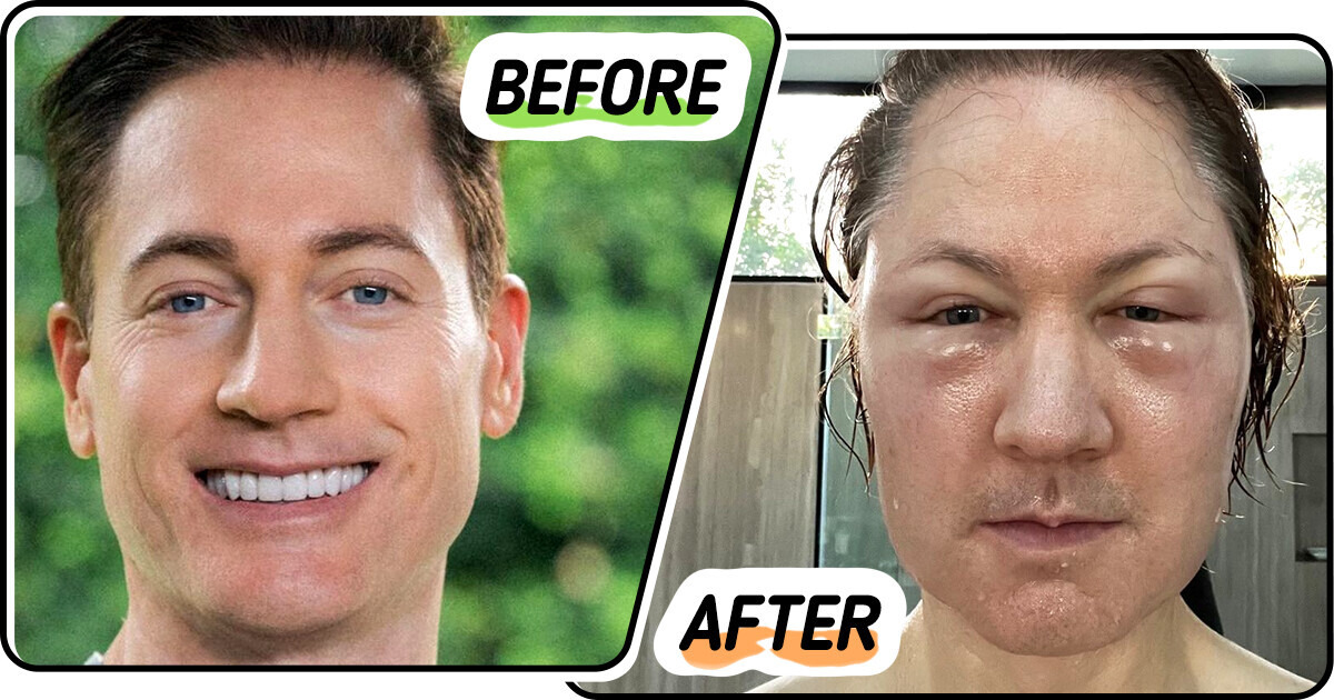 Anti-Aging Guru Bryan Johnson Shows How His Attempt to Turn Back the Clock Turned Into a Disaster Anti-Aging Guru Bryan Johnson Shows How His Attempt to Turn Back the Clock Turned Into a Disaster