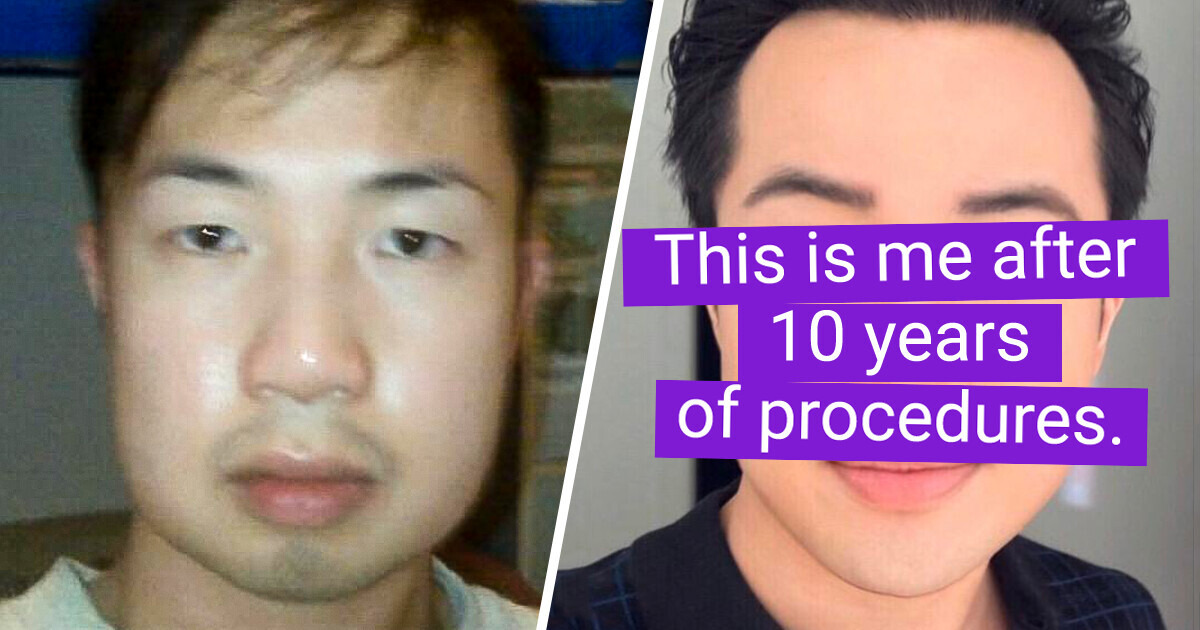 A Guy With Phenomenal Plastic Surgery Results Draws a Surprising Conclusion About Happiness A Guy With Phenomenal Plastic Surgery Results Draws a Surprising Conclusion About Happiness