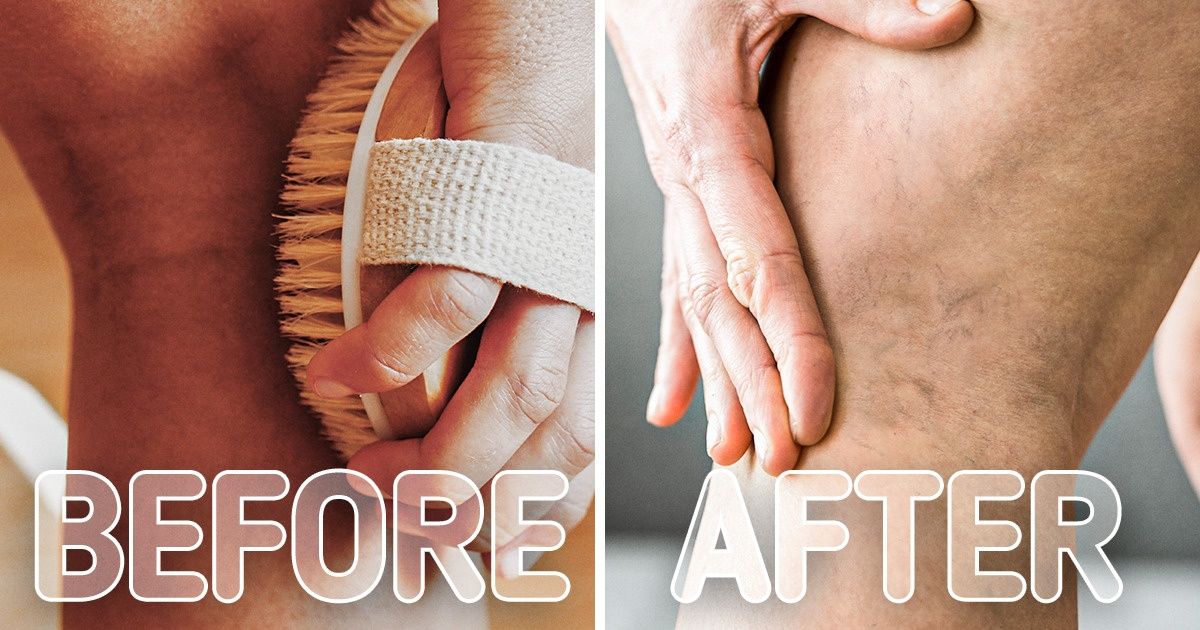 7 Daily Habits That May Damage Your Veins