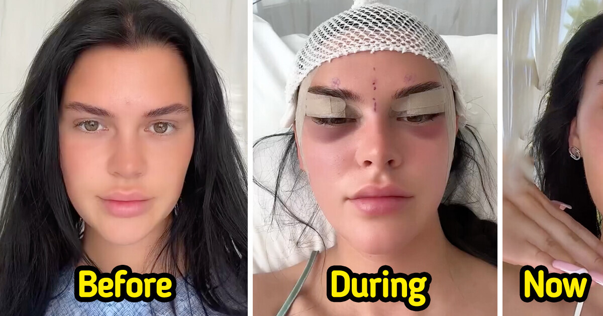 Young Woman Documents Her Fox Eye Surgery and Shocks People With the Results Young Woman Documents Her Fox Eye Surgery and Shocks People With the Results