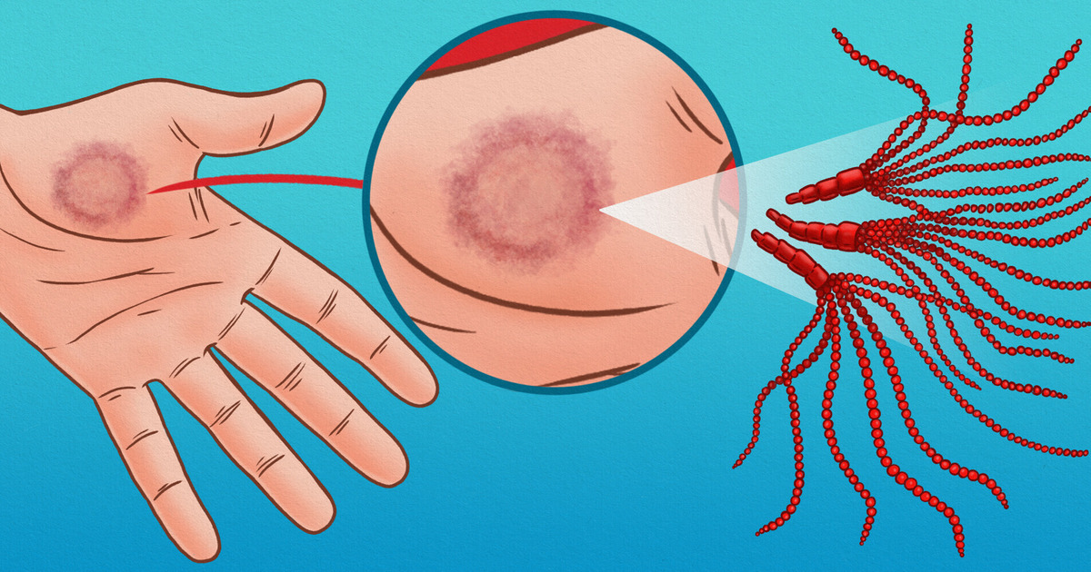 7 Home Remedies for Skin Fungus That Actually Work 7 Home Remedies for Skin Fungus That Actually Work