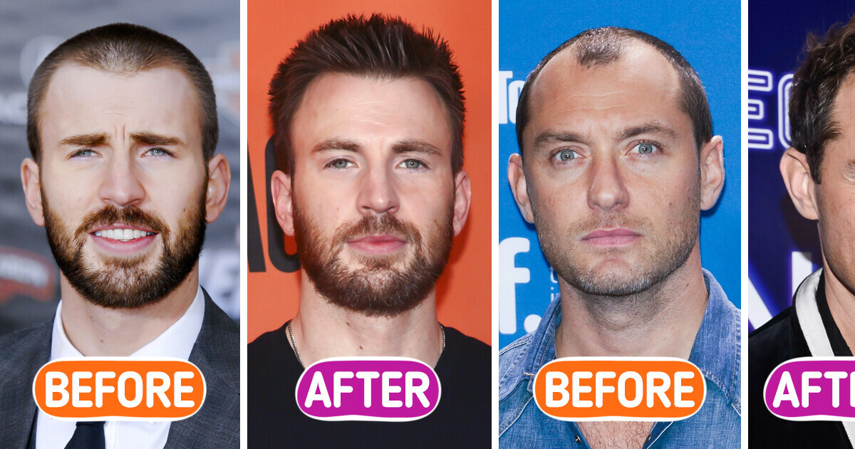 What 12 Famous Men Looked Like Before They (Allegedly) Got Hair Transplants What 12 Famous Men Looked Like Before They (Allegedly) Got Hair Transplants