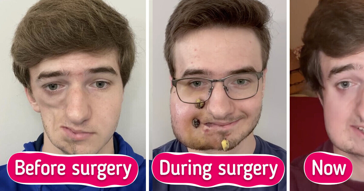 Man with Parry-Romberg Syndrome Reveals How He Looks Today Man with Parry-Romberg Syndrome Reveals How He Looks Today