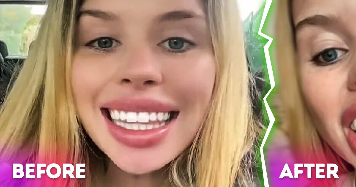A Woman Bought a New Pair of Veneers and Her Confused Reaction Went Viral