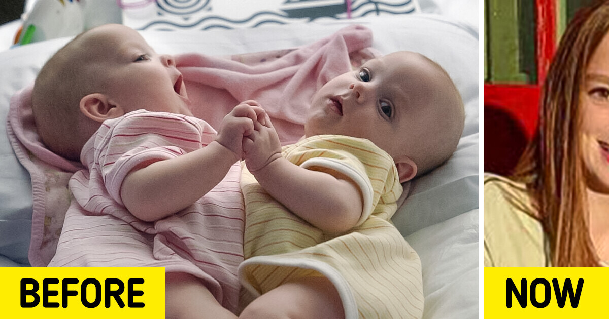 The Story of the Conjoined Twins Who Were Successfully Separated and How They Look Now