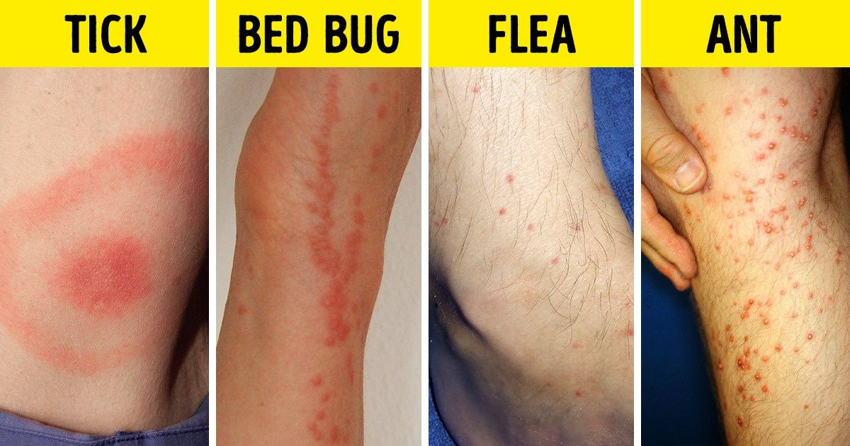 How To Identify A Bug Bite And What To Do With It