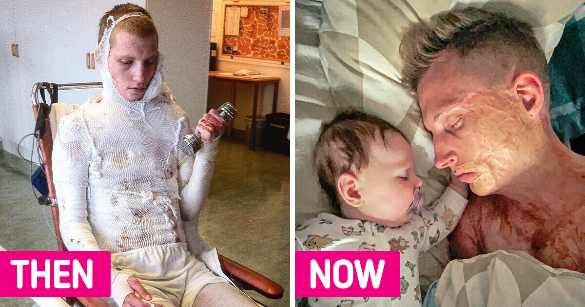 A Singer Who Had Most of His Body Burned by Electrocution Is Embracing His Uniqueness A Singer Who Had Most of His Body Burned by Electrocution Is Embracing His Uniqueness