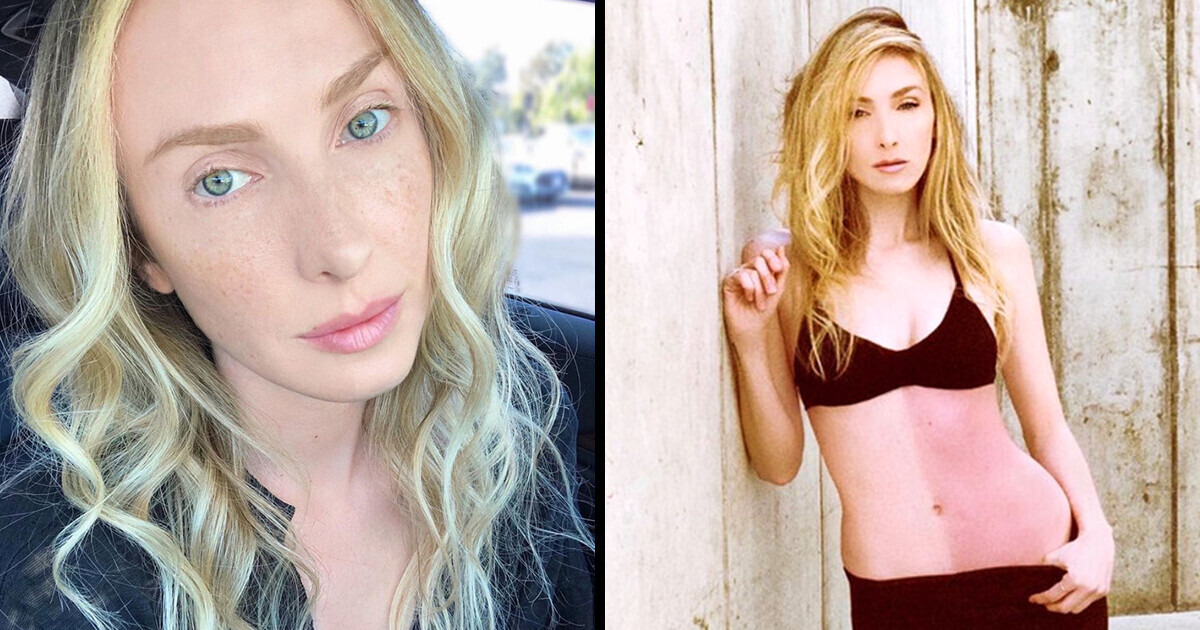 “I’m My Own Twin,” Model Shares the Unique Condition of Being Fused With Her Twin Sister in the Womb