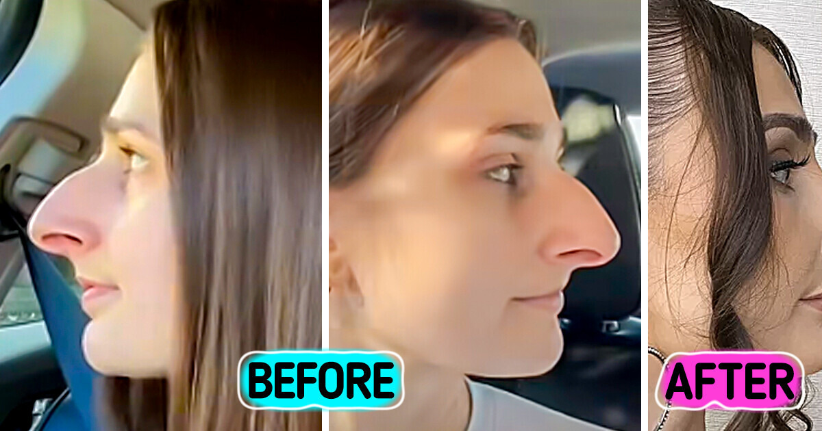 Woman Spends Over a Decade Saving for a Nose Job—The Results Leave People Stunned Woman Spends Over a Decade Saving for a Nose Job—The Results Leave People Stunned