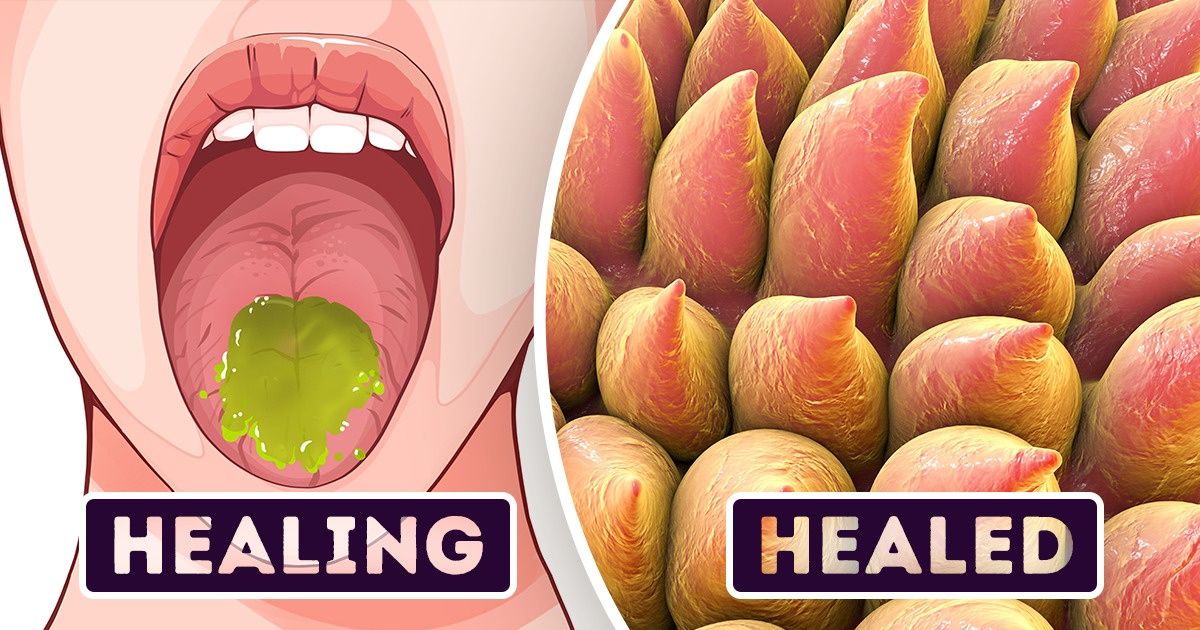 10 Ways To Heal A Burnt Tongue After Eating Hot Food Bright Side